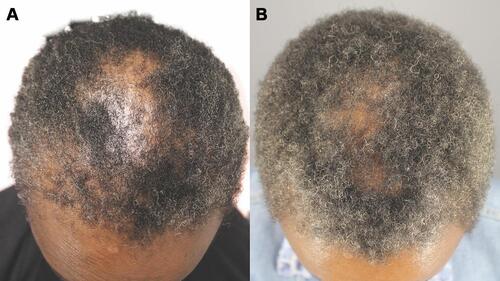 Figure 1 Vertex of the head of the patient from a previously authored study Images of the top of the head of a patient diagnosed with central centrifugal cicatricial alopecia obtained before (A) and after (B) 3 months of using Gashee lotion alone are shown. These images are used with permission from Case Reports in Dermatological Medicine (Umar S, Carter MJ. A multimodal hair-loss treatment strategy using a new topical phytoactive formulation: a report of five cases. Case Rep Dermatol Med. 2021;2021:6659943. Published online February 4, 2021. doi: 0.1155/2021/6659943; Figure 9).