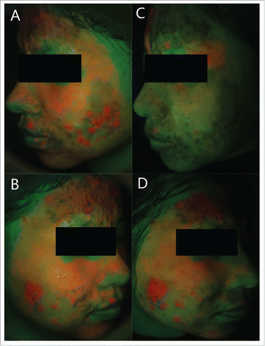 Figure 1. Fluorescence images of left and right side face of one patient. Acne lesions on the right side were treated by red light-PDT and acne lesions on the left side were treated by IPL-PDT. (A)(B) Fluorescence images immediately before light irradiation. (C) Fluorescence image immediately after red light irradiation.(D) Fluorescence image immediately after IPL irradiation. The intensity of brick-red colour was decreased after red light irradiation.