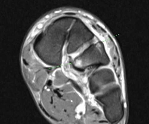 Figure 2. Magnetic resonance imaging highlighting traumatic stress response