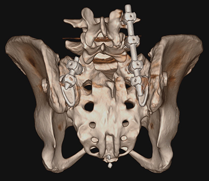 Figure 2 The custom implant (left) allows connection to a lumbar stabilization system (right).