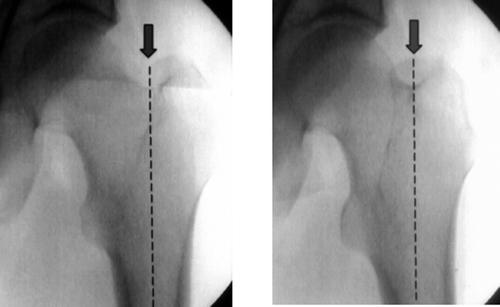 Figure 1. In the AP view, the entry point for the intramedullary femoral nail is exactly within the extended medullary canal line (two different rotational positions are shown).