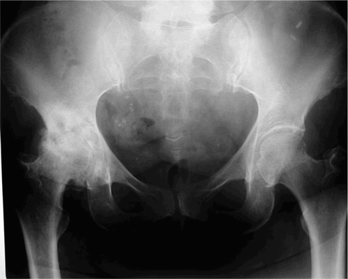 Figure 2. Radiograph of osteoarthritis in right hip joint with moderate loss of sphericity of the head and severe narrowing of the joint space. The left hip is normal.