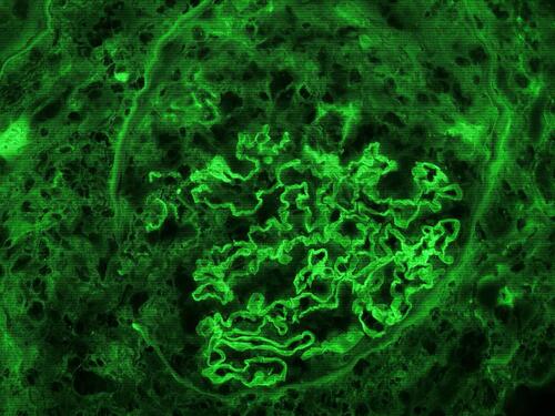 Figure 2 Immunofluorescent microscopic image showing intense linear deposition of IgG along the glomerular capillaries. The adjacent crescent is devoid of fluorescence (magnification 400 X).