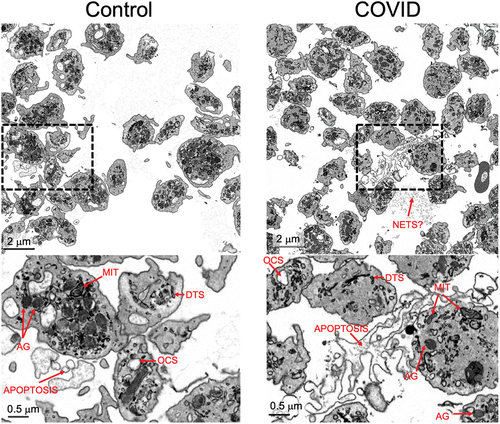Figure 2. Organelle morphology in platelets from Control and COVID-19 patients. Images with two different magnifications are shown of platelets from a Control (Control donor 3, left) and a COVID-19 patient (COVID 2, right). Identified features are indicated: mitochondria (MIT), α-granules (AG), open canalicular system (OCS), dense tubular system (DTS), possible neutrophil extracellular traps (NETS?), and apoptotic bodies (apoptosis).