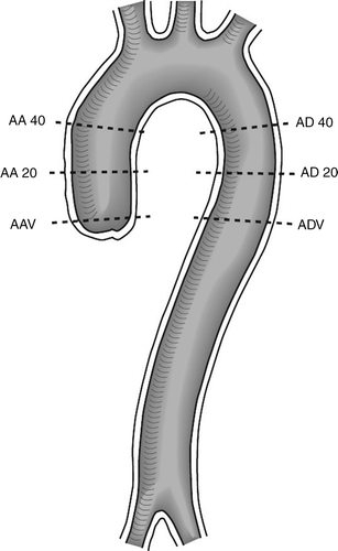Figure 1.  Sagittal view over the thoracic aorta. The figure shows were the measurement were made. AV = the level of the aortic valve, AV20 = 20 mm over the aortic valve, AV40 = 40 mm over the aortic valve, AD40 – AD20 – ADV = corresponding levels in the descending aorta.