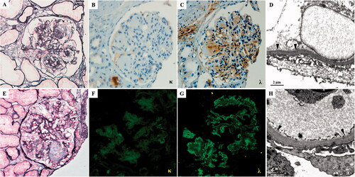 Figure 1. The pathological findings of the first (A–D) and second (E–H) renal biopsy. (A) The glomeruli exhibit sclerotic mesangial nodules with severe mesangial hypercellularity (PASM, ×400). (B) Kappa light chain is negative by immunohistochemistry staining on paraffin tissue (×400). (C) Lambda light chain deposit in nodular sclerosis area and along capillary wall and TBM by immunohistochemistry staining on paraffin tissue (×400). (D) Electron microscopy of formalin-fixed renal tissue. The granular dense (arrowhead) deposits along the inner side of GBM (×12,000). (E) The nodular sclerosis was significantly reduced than the first biopsy (PASM, ×400). (F) The kappa-light chain stains negatively. (G) Immunofluorescence staining showed that the lambda-light chain is positive along the capillary wall of glomeruli (×400). (H) Electron microscopy. There is trace granular (arrowhead) dense deposition along the inner side of GBM (×12,000).