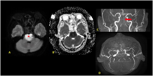 Figure 2. MRI Brain with axial diffusion restriction image (A) and apparent diffusion coefficient (ADC) (B) map shows an area of diffusion restriction in the pons (⋆) with a signal drop on the ADC, in keeping with acute pontine infarction. 3D TOF MR angiography (C, D) show complete loss of flow-related signal of the basilar artery (red arrow) indicating occlusion.
