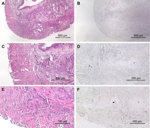Figure 3 High-grade muscle-invasive bladder cancer induced by BBN treatment at 17 weeks without gold injection. (A) H&E, 40×; (B) gold enhanced, 40×; (C) H&E, 100×; (D) gold enhanced, 100×; (E) H&E, 200×; (F) gold enhanced, 200×.Abbreviations: H&E, hematoxylin and eosin; BBN, N-butyl-N-(4-hydroxybutyl)nitrosamine.