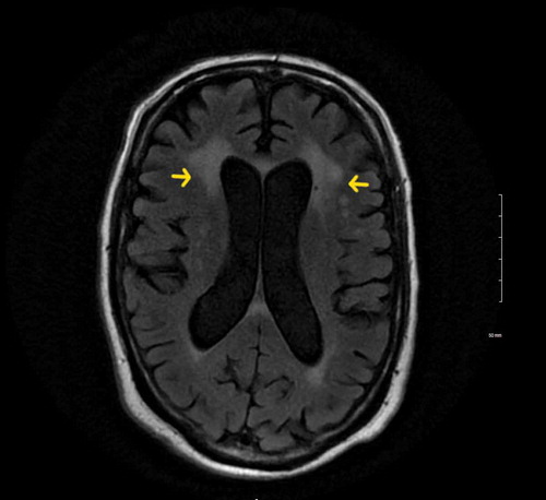 Figure 2. MRI of the brain showing bilateral periventricular white matter lesions.