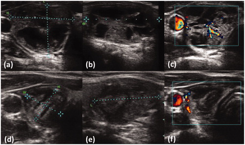 Figure 3: Patient with dextral nodule showing unifocal thyroid autonomy before RFA (a) and 3 months after (b). Ultrasound measurements revealed a relative reduction of 77.5%. (a) length = 19 mm; height = 24 mm; width = 36 mm; volume = 8.0 cm³. (b) length = 23 mm; height = 12 mm; width = 13 mm; volume = 1.8 cm³. After ablation the patient developed a euthyroid state of function. Sufficient ablation was verified by using Doppler blood flow before ablation (c) and 3 months after the procedure (d), showing a loss of central perfusing vessels as a sign of efficient treatment.