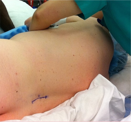 Figure 4 Patient in the lateral decubitus position for intrathecal drug delivery system implantation. The blue surgical mark indicates anticipated lumbar midline incision for intrathecal catheter placement. Photograph courtesy of MMB.
