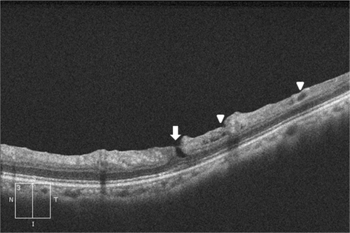 Figure 3 Optical coherence tomography reveals the defects of the inner layer of the retina equivalent to the partial tear (arrow) and small surface break (arrowhead).
