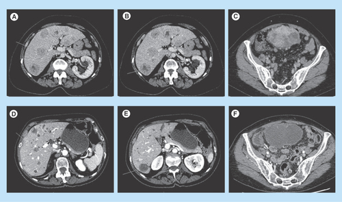 Figure 1.  Response to regorafenib of a PDGFRA mutated GIST. Response to regorafenib in a patient with liver metastasis (A, B, C) before treatment; (D, E, F) response maintained 18 months after treatment onset) from a PDGFRA exon 18 mutated gastrointestinal stromal tumor.