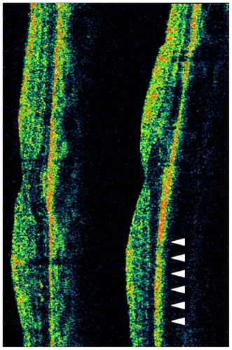 Figure 3 Optical coherence tomography of both eyes with vertical scan (left). Optical coherence tomography image shows normal foveal structure in the right eye (right). The inferior part of outer retinal layer seems to be thin in inferior area of the left eye (arrowhead).