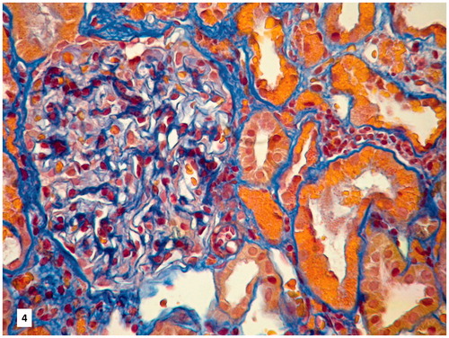 Figure 4. Apparently normal glomerulus, with mild tuft hypertrophy (AFOG staining, original magnification 200×).