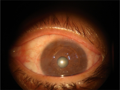 Figure 1B Appearance of the eye 3 months after the initial treatment cycle with topical 5-FU.