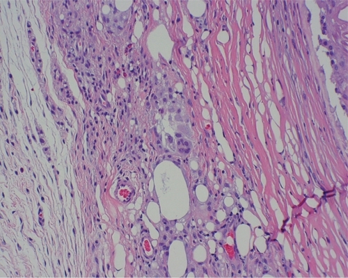 Figure 3 High power view of biopsy specimen from lower lip. A multinucleated foreign body-type giant cell is visible in the center of the photomicrograph. (Hematoxylin and eosin, original magnification 60×).