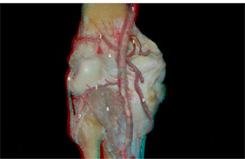 Figure 7 Posterior view of the knee: lateral inferior genicular artery and the posterolateral compartment structures: popliteal artery (1), lateral superior genicular artery (2), medial superior genicular artery (3), posterior septum of the knee (4), lateral inferior genicular artery (5), collateral lateral ligament (6), popliteofibular ligament (7), popliteal muscle (8), and medial inferior genicular artery (9).