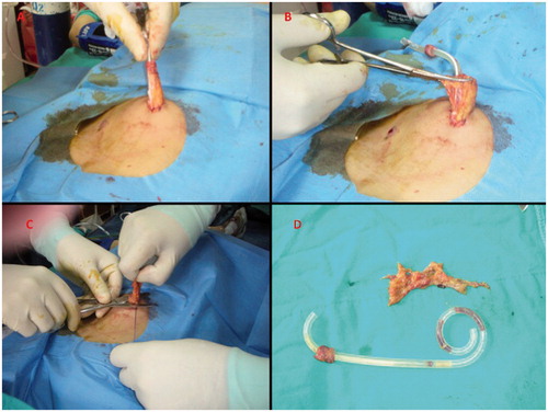 Figure 1. The performance of percutaneous partial omentectomy. Omental wrapping or adhesion at the tip of the catheter (A). The seperation of omentum portion that protrude from the port site from the catheter (B). After removal of the catheter, the ligation of and cut away the omentum part from the bottom (C). The sample of the omentum part removed (D).