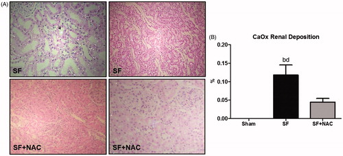 Figure 5. N-acetylcysteine (NAC) attenuates calcium oxalate (CaOx) deposition in renal parenchyma. (A) Representative rat kidney sections performed after star fruit juice ingestion and 48 h of water or n-acetylcysteine interventions. SF group exhibits intense calcium oxalate birefringence crystals deposition under polarized light microscopy and dilatation of renal tubules and tubular epithelium degeneration and flattening. Arrow: intratubular oxalate crystals. SF + NAC group shows discrete deposits of calcium oxalate and absence of tubular alterations, compatible with the lowest oxaluria observed in this group (Polarized hematoxylin and eosin; original magnification ×100 and ×400). (B) CaOx deposition throughout the kidney samples. Data were expressed in volume ratios of positive areas of renal tissue (%). SF (Star fruit group), SF + NAC: star fruit + NAC therapy, Sham: control group. Data are mean ± SEM; ap < .001, bp < .01 vs. Sham; cp < .001, dp < .01 vs. SF + NAC.