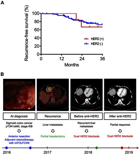 Figure 3 Clinical outcomes of HER2-positive and -negative colorectal cancers (CRCs). (A) Kaplan–Meier estimates of recurrence-free survival for HER2-positive and -negative patients with CRC. (B) A 75-year-old lady was diagnosed with stage III sigmoid colon cancer in the end of 2015. Standard surgical resection was performed at that time followed by adjuvant chemotherapy with mFOLFOX6. Liver metastases (white dotted circle) developed 2 years later. Despite curative surgical resection, recurrent liver metastases (red arrow) were detected soon after the surgery for liver metastases. Dual anti-HER2 blockade was initiated based on HER2 overexpression in both primary and recurrent tumors. Computed tomography scans obtained 2 months after anti-HER2 therapy demonstrated significant shrinkage of liver metastases (white arrow).