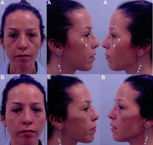 Figure 9 Frontal, right, and left projection of a 40-year-old patient face before (A) and after (B) being treated. The patient provided their consent for the use of their image in this publication. 1. Zygomatic arch (Ck1): 0.3 mL per side of Hyaluronic acid filler (VYC-20L). 2. Anteromedial cheek (Ck3): 0.7 mL per side of Hyaluronic acid filler (VYC-20L). Image courtesy with permission from Dr Farollch. Codes have been adapted from de Maio.Citation10