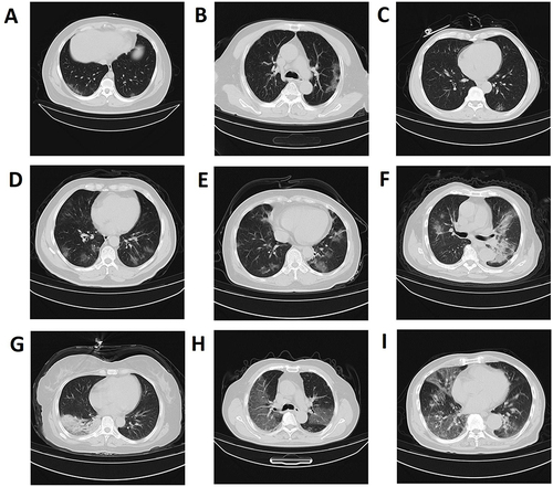 Figure 2 CT images in pneumonia COVID-19 patients infected by SARS-CoV-2 Omicron variant. (A–C), peripheral ground glass lesions. (D and E), scattered ground-glass lesions in both lungs. (F and G), local consolidation.(H and I), diffuse ground glass lesions in both lungs.