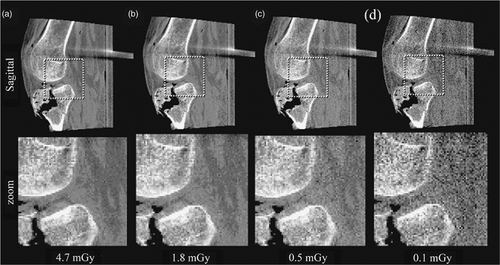 Figure 6. Each column illustrates a CBCT sagittal view, with a magnified portion in the region of the fracture shown in the bottom row. At the nominal dose level (4.7 mGy), excellent delineation of fine, high-contrast structures as well as soft tissues is observed. Below ∼0.5 mGy, image quality rapidly degrades due to increased image noise.