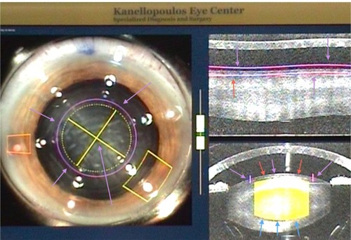 Figure 2 The LenSx® (Alcon, Fort Worth, TX, USA) femtosecond laser capsulorhexis, lens fragmentation, and cornea incision final plan. The capsulorhexis planned is shown by the purple arrows both on the left (coronal) and right (cross-sectional) images of this intraoperative optical coherence tomography planning tool. The lens fragmentation plan is shown by the yellow crosshairs and arrows in the left coronal view. Of note is that the planned lens fragmentation diameter is narrower than the capsulorhexis diameter. On the right view, the lens fragmentation is shown in cross section. Its anterior extent, just under the anterior capsule, is shown by red and magenta arrows. The posterior extent is shown by the blue arrows and is 500 microns short of the posterior capsule.