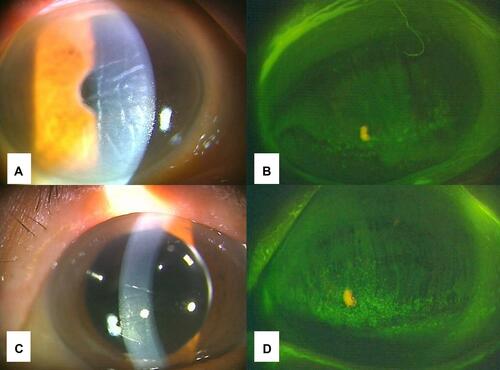 Figure 4 Clinical findings of the anterior segment at the first visit for case 1. (A, C) Photograph of the anterior segment of the right (A) and left (C) eyes. Folds of Descemet’s membrane were observed. (B, D) Photograph of the cornea of the right (B) and left (D) eyes after the use of fluorescein. Superficial punctual keratitis was bilaterally observed but corneal epithelial defect was not observed.