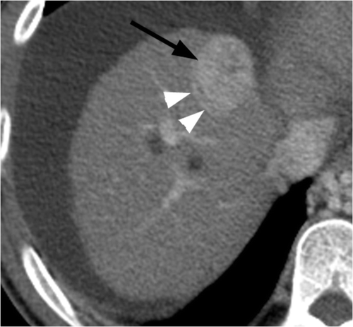 Figure 3 Axial portal venous phase CT image in an 84-year-old woman with Nash and an HCC (black arrow) involving segment VIII of the liver. A hepatic vein (white arrowheads) is seen abutting tumour along its posterolateral aspect. Before performing blinded CT assessment, the modified heat capacity was determined to be 670.91 J/°C.