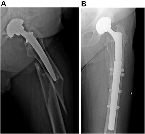 Figure 3 Preoperative anteroposterior radiograph of a Vancouver type-B2 periprosthetic femoral fracture in a 61-year-old man (A) treated with an uncemented femoral revision (B). Fracture was healed and uncemented modular tapered fluted revision stem was well osteointegrated after 1 year of surgery.
