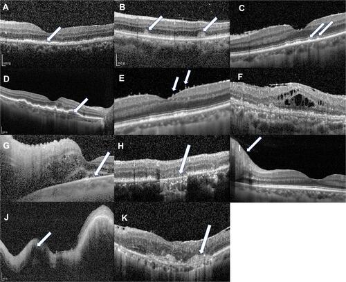 Figure 1 OCT abnormalities in the VRL group. (A) Outer retina (OR) fuzzy borders (B) focal subretinal deposits (C) hyperreflective subretinal dots (D) pigment epithelium detachment (PED) (E) preretinal deposits (F) epiretinal membrane and cystoid macular edema (G) subretinal fluid (H) outer retina atrophy (I) unilateral optic papilledema (J) retinal thickening (K) subretinal fibrosis.