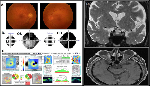 Figure 1 Case on presentation. (A) Fundus photography reveals bilateral optic disc edema. (B) Visual fields with severe diffuse depression in the right eye (mean deviation −30.15 dB) and bi-arcuate defects in the left eye (mean deviation −20.2 dB). (C) OCT showing ganglion cell complex loss in both eyes and increased bilateral RNFL thickness of 104 microns in the right eye and 165 microns in the left eye, due to optic disc edema. (D) Top, Coronal T2 MRI image showing increased thickening of the anterior chiasmatic optic nerves with central T2 hyperintensity. Bottom, axial T1 postcontrast MRI imaging showing no optic nerve enhancement.