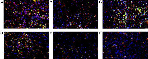 Figure 8 CD8+ TILs (red), PD-1+ TILs (green) and DAPI (blue) expression in tumor microenvironment of mice inoculated with breast cancer cells. (A) Inoculation of 4T1 cells. (B) Inoculation of 4T1 cells and metformin administration. (C) Inoculation of 4T1 cells with JNK knock-down. (D) Inoculation of 4T1 cells with JNK overexpression. (E) Inoculation of 4T1 cells with JNK knock-down and metformin administration. (F) Inoculation of 4T1 cells with JNK overexpression and metformin administration.