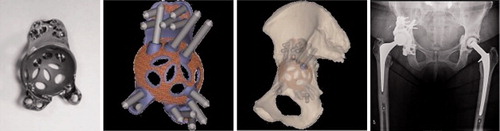 Figure 2. Custom made impalnt, planned screw positions and implant position based on CT scan. CT was taken prior to surgery. The radiograph shows the postoperative result. The position of the implant after surgery was compared with the preoperative planning using the pre- and postoperative CT scans.