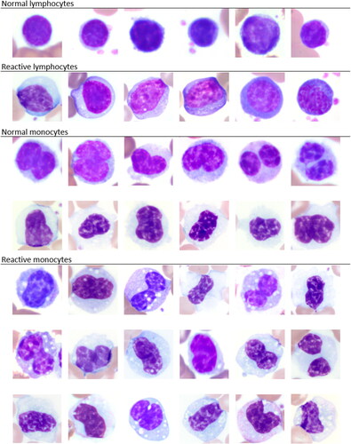 Figure 1. Image composite of normal and reactive lymphocytes and monocytes, respectively, in elephants as commonly recognized by blood film evaluation. x100 objective. Wright-Giemsa stain.