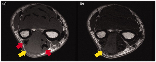 Figure 2. Preoperative MRI findings. (a) MRI (T1-weighed image): the mass was slightly hyperintense compared to the muscle and pushing outward against the extensor tendons (arrows). (b) MRI (T2-weighed image): the mass was slightly hyperintense compared to the muscle (arrows).