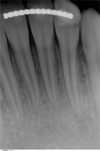Figure 9 Periapical radiograph of mandibular incisors showing healthy pulp and periodontal tissues.