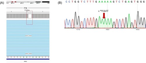 Figure 2. The TGS result and validation of α−91. Integrative Genomics Viewer plot identified by TGS. The red box represents α−91 (-T) in HbA2(A). Sanger sequencing confirmed for the novel mutation (B).