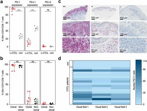 Figure 4. PD-1 is significantly overexpressed, PD-L1 significantly decreased and PD-L2 is low on T cells in the skin of patients with L-CTCL when compared with T cell population in healthy individuals. (a) PD-1, PD-L1 and PD-L2 expression analyzed by flow cytometry in skin-derived CD3+CD8− T cells isolated from biopsies of L-CTCL patients (n = 6) and healthy individuals (n = 4) using short-term explant technique. (b) Expression of PD-1, PD-L1 and PD-L2 in the tumor (clonal) and non-tumoral bystander (non-clonal) T cells from L-CTLC skin lesions. In at least one of the samples analyzed in a) and b), there was a partial aberrant loss of CD4 on the tumor cells. For consistency throughout all the samples, a gating strategy on CD3+ CD8-T cells was applied. (c) Representative images of paraffin-embedded CTCL (MF and SS) skin biopsies with high expression of PD-1 (++/≥50%), with moderate expression of PD-1 (+/5-50%), and negative for PD-1 (-/<5%). (d) Graphic visualization of PD-1 expression in CTCL skin lesions (n = 18). Evaluation of three visual fields of each slide demonstrates variable positivity for PD-1 in CTCL on immunohistochemistry. Abbreviations: ns: P > .05; ***: P ≤ 0.001; nlm: healthy donors