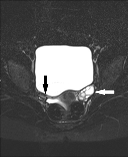 Figure 3 Axial short TI inversion recovery magnetic resonance image showing absent right adnexa and blunt ending right fallopian tube.