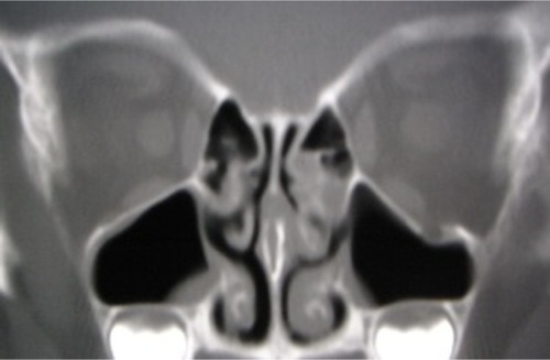 Figure 2 Computed tomography 6 months after the injury shows the regeneration of the left orbital floor and no abnormalities in the left maxillary sinus.