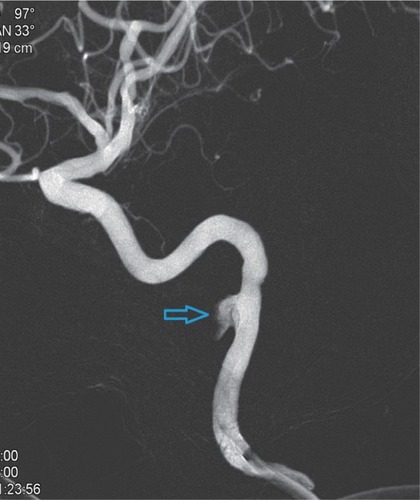 Figure 6 Vascular imaging of the pseudoaneurysm after 3D reconstruction (indicated by the arrow).