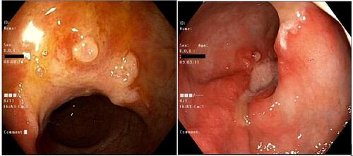 Figure 4 Colonoscopy: A single (solitary) 16 mm ulcer in the mid rectum around 10 cm from anal verge. A hyperplastic polyp in the sigmoid colon around 4 mm in size.