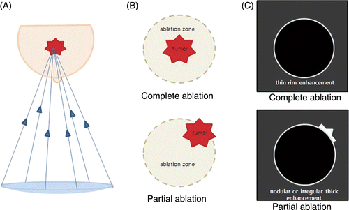 Figure 1. Diagrams of technical effectiveness. (A) Illustration of HIFU therapy. (B) Illustration of the technical effectiveness as divided into complete versus partial ablation. (C) Illustration of the technical effectiveness as depicted on a MR subtraction image: thin rim enhancement for complete ablation and nodular or irregular thick enhancement for partial ablation.