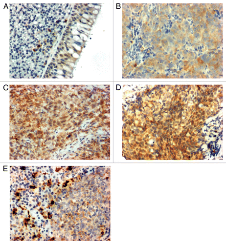Figure 2. Leukemia inhibitory factor (LIF) expression in nasopharyngeal tissues. (A) Normal basal epithelium. (B) Nasopharyngeal carcinoma (NPC) tumor diagnosed as complete tumor remission after therapy. (C) NPC tumor diagnosed with relapse after therapy. (D) NPC tumor diagnosed with distant metastasis after therapy. (E) Macrophages residing within NPC tumor areas.