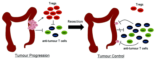 Figure 1.Illustration of the effects on the anti-tumor immune response of surgery. Primary colonic tumors may inhibit immune responses both directly and indirectly by driving Tregs. Resection could reverse both these processes allowing potentially useful anti-tumor immune responses to emerge.