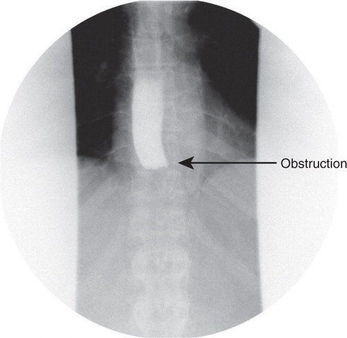 Fig. 1 Barium swallow showing complete esophageal obstruction in the distal esophagus.