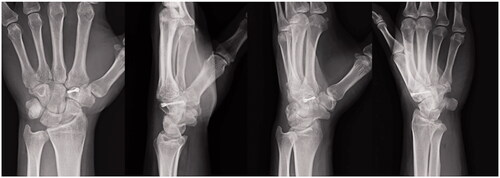 Figure 5. Postoperative X-ray images obtained at one year after surgical fixation of an isolated left trapezoid coronal shearing fracture in a 40-year-old male. Complete bone union and appropriate alignment of the proximal and distal carpal rows are visible. No arthritic changes of the second carpometacarpal joint or necrosis of the trapezoid can be seen.